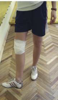 После операции перелома ноги в колене thumbnail